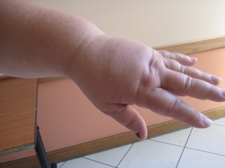 Photo d'un bras avec lymphoedème dont le gonflement constitue l'un des principaux signes et symptômes