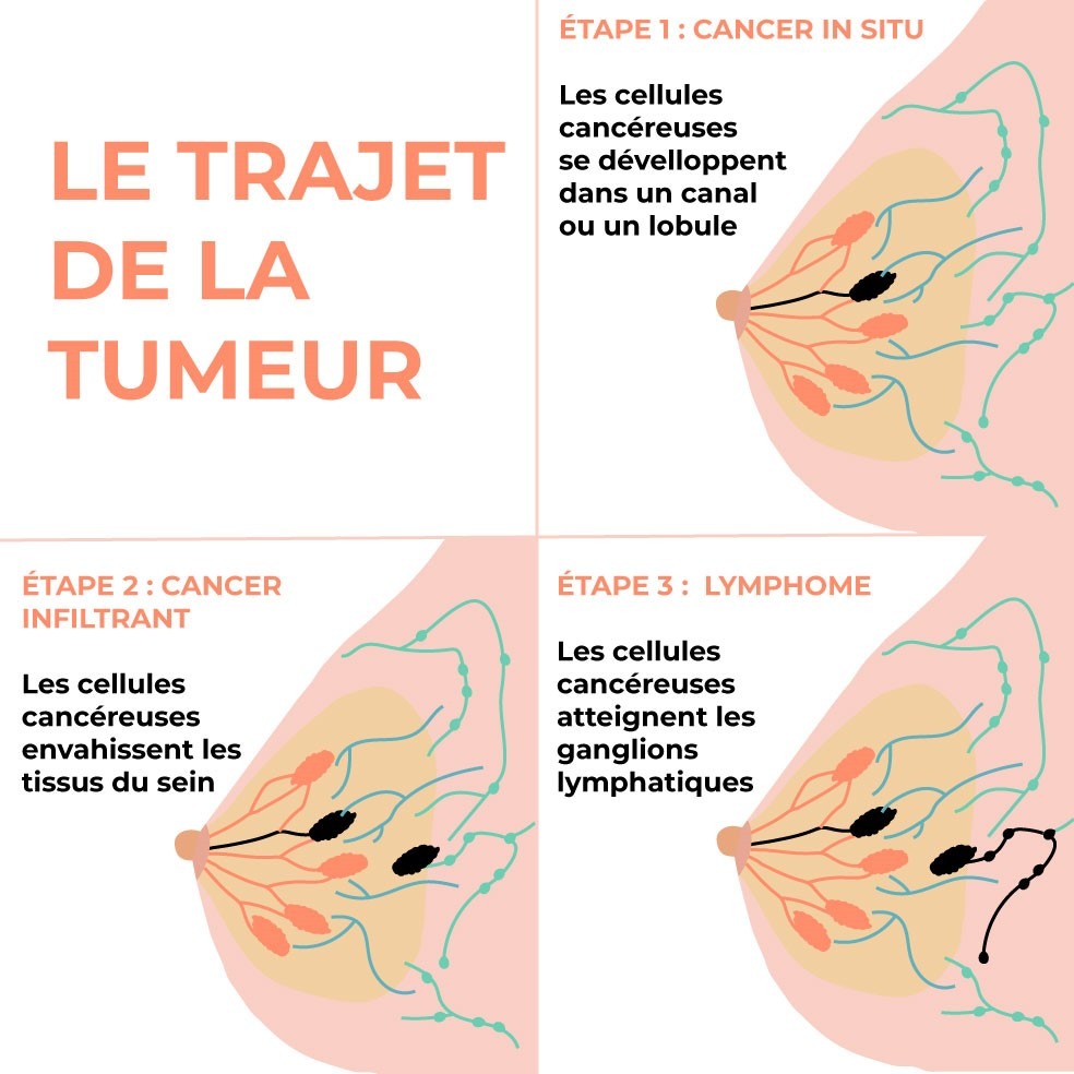 Dessin de la formation de tumeurs, un des symptômes du cancer du sein