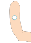 Illustration d'un capteur de glycémie dans le bras, que l'on peut recouvrir de manchons de protection
