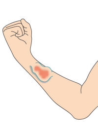 Illustration d'une fistule artérioveineuse à l'avant du bras, que l'on peut recouvrir de manchons de protection
