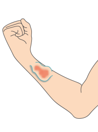 dessin_fistule_artérioveineuse Illustration d'une fistule artérioveineuse à l'avant du bras, que l'on peut recouvrir de manchons de protection