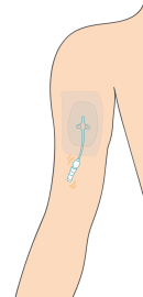 dessin_piccline Illustration d'un PICC Line, cathéter dans le bras, que l'on peut recouvrir de manchons de protection