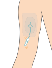 Illustration d'un PICC Line, cathéter dans le bras, que l'on peut recouvrir de manchons de protection
